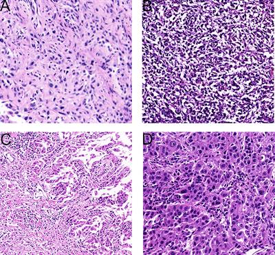 Frontiers | Characteristics and Prognostic Analysis of 55 Patients With ...